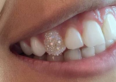 Tooth gems are sparking joy in Greater Boston - The Boston Globe